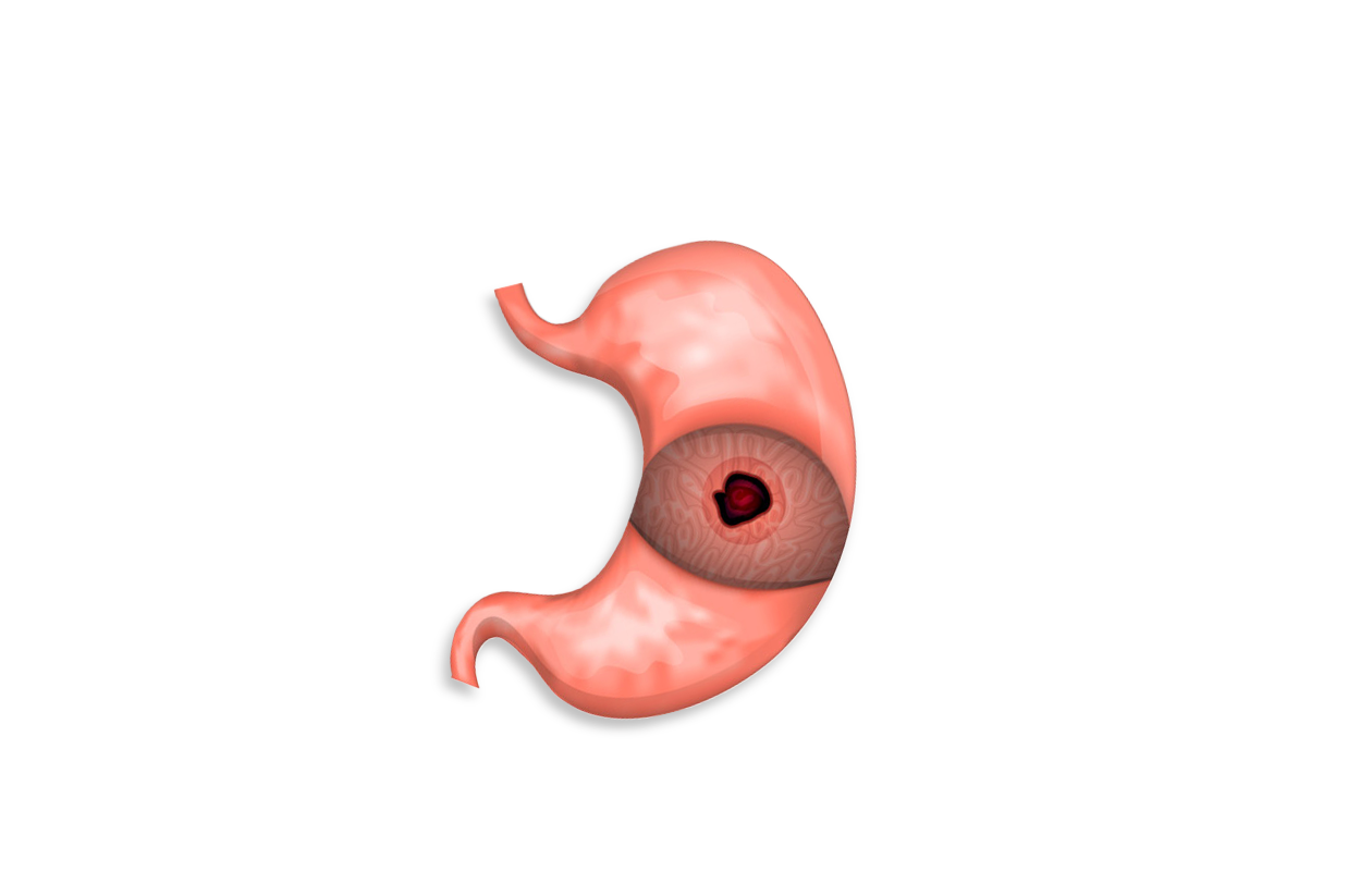 Image of a stomach with a painful ulcer
