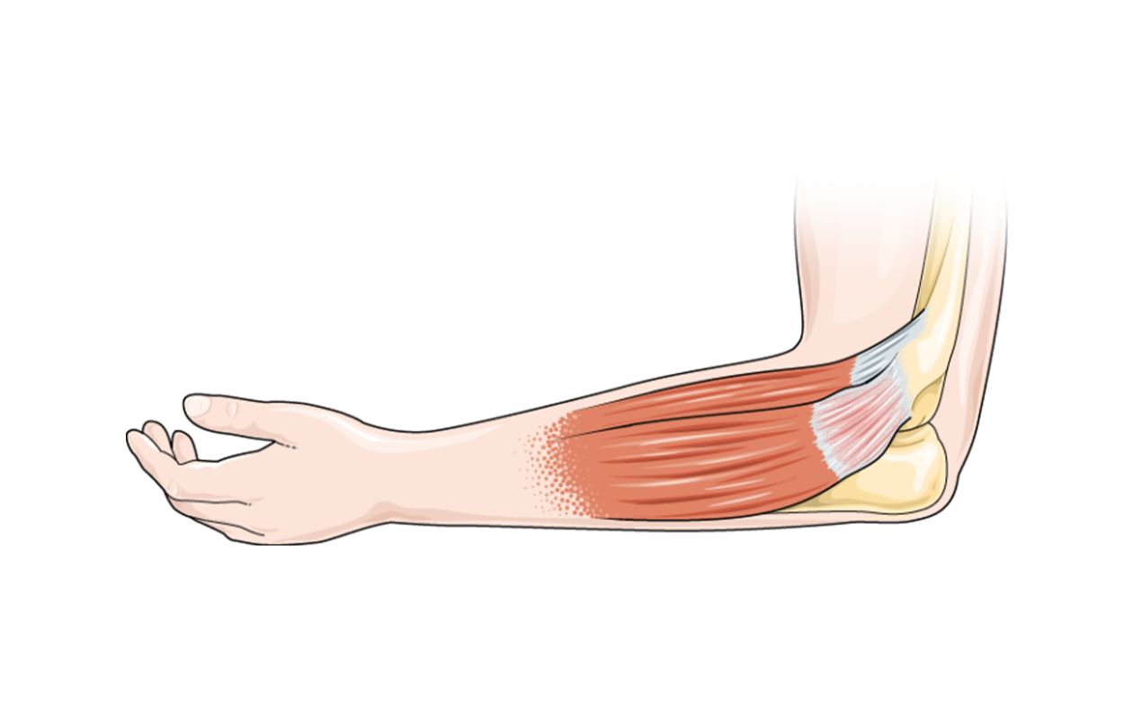 Graphical photo of a persons arm showing tendons near the elbow with there is tendonitis