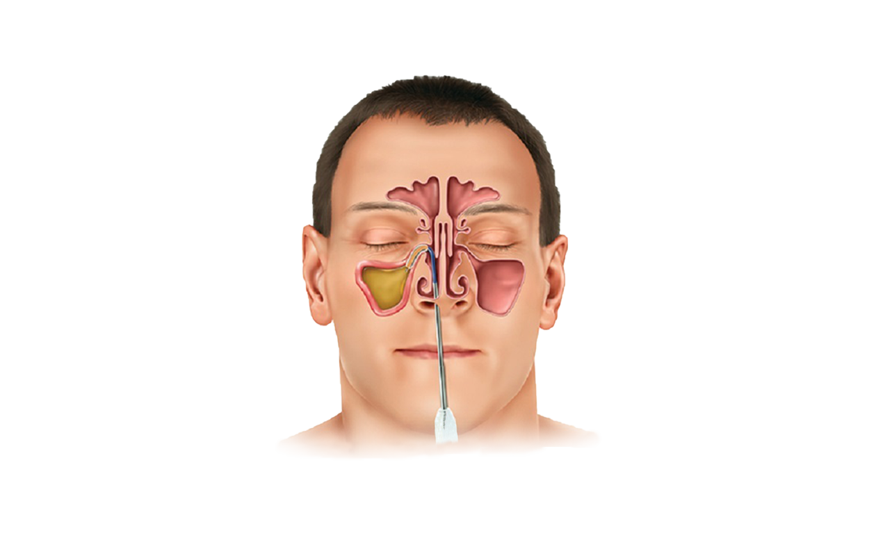 Image depicting front of person's face showing nasal and sinus passages 