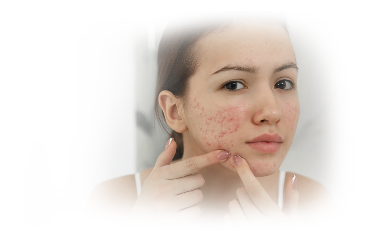 Image of young woman with scaring and pimples on cheek from acne.