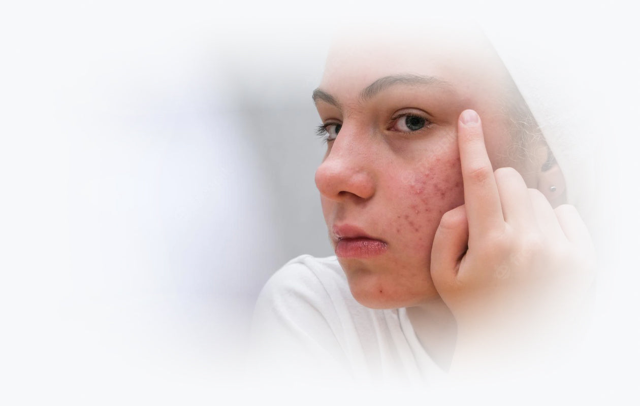Image of person with acne on face