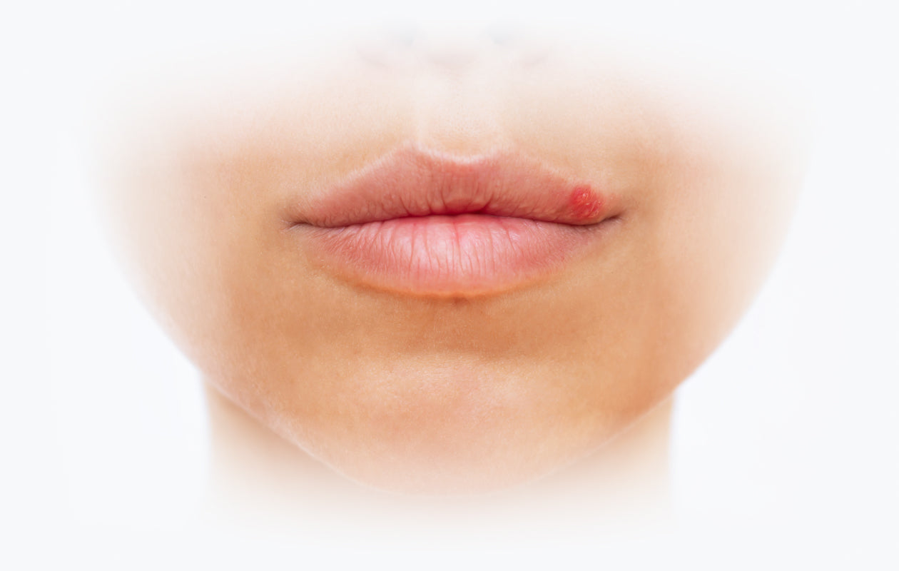 Close photo of lips with cold sore.